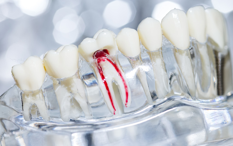 Điều trị tủy răng loại bỏ tủy viêm/nhiễm trùng, sau đó trám kín ống tủy và răng đã điều trị.