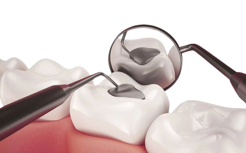 Độ bền của vật liệu trám răng sâu rất khác nhau tùy thuộc vào loại vật liệu được sử dụng. 