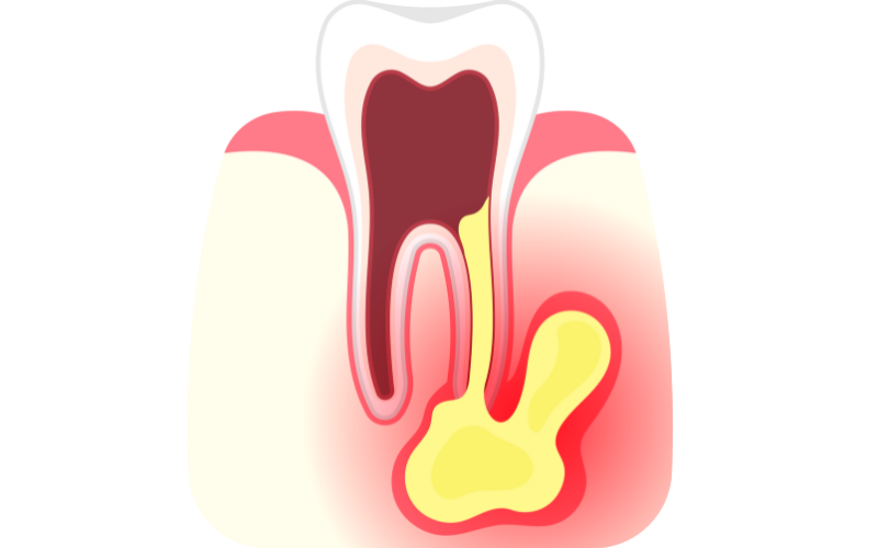 Nguyên nhân phổ biến nhất gây viêm tủy răng là do vi khuẩn xâm nhập vào tủy thông qua các lỗ sâu răng hoặc các vết nứt trên răng. 