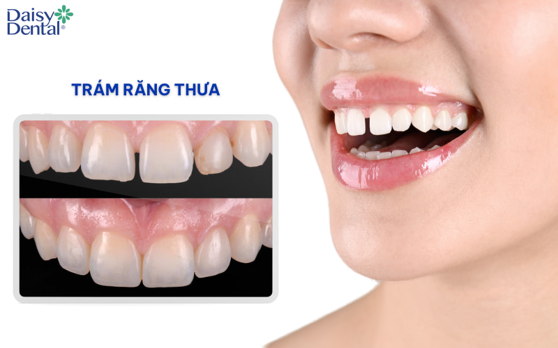 Trám răng thưa là kỹ thuật nha khoa nhằm khắc phục tình trạng có khoảng trống giữa các răng, thường thấy nhất là ở răng cửa