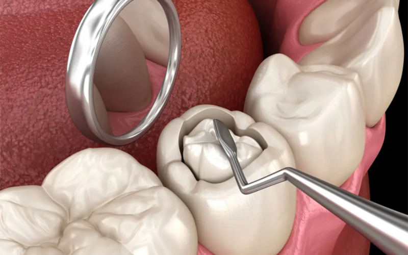 Sâu răng là một trong những lý do hàng đầu khiến chúng ta cần đến nha sĩ để trám răng. 