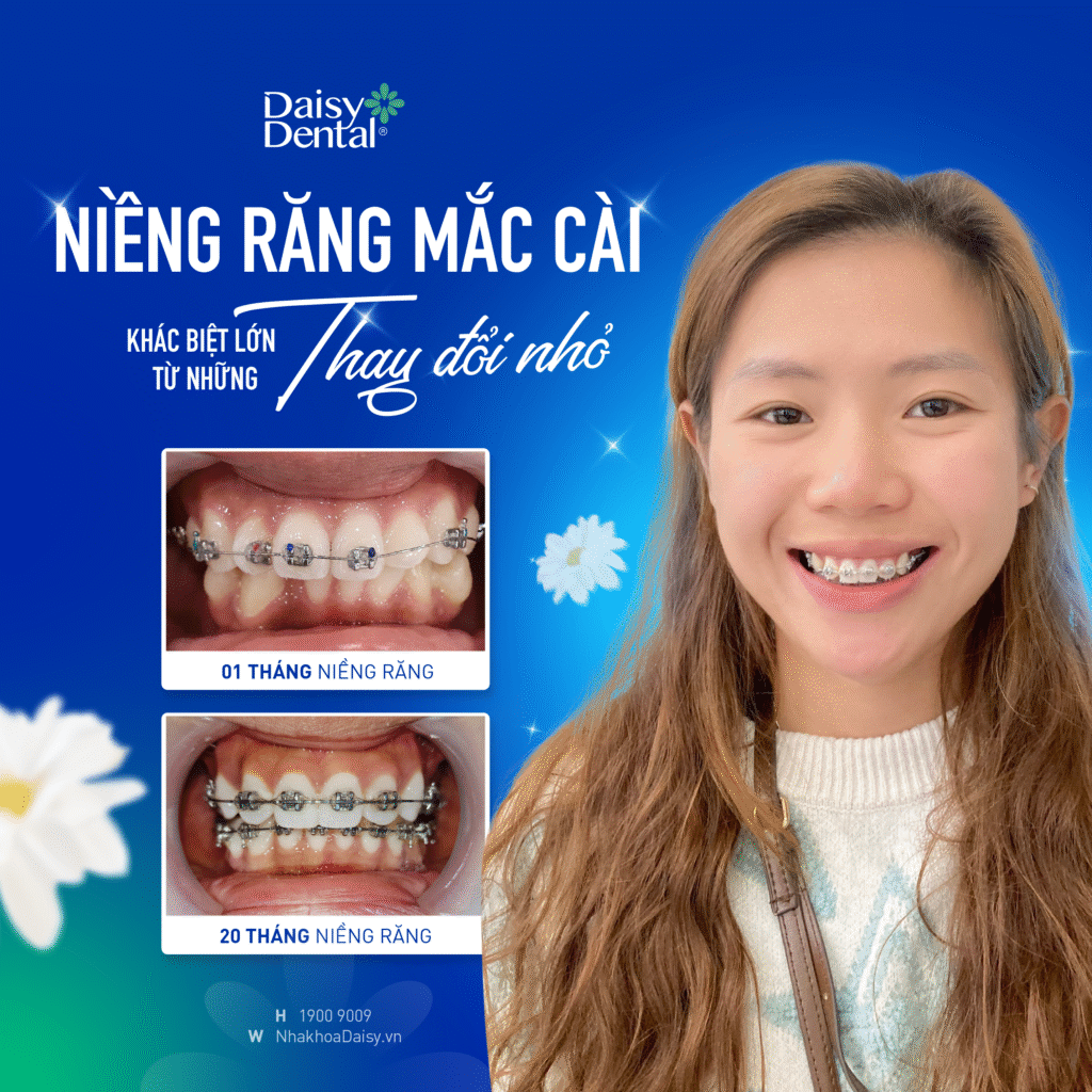 Dấu hiệu cho thấy bạn cần đi khám nha khoa ngay lập tức.